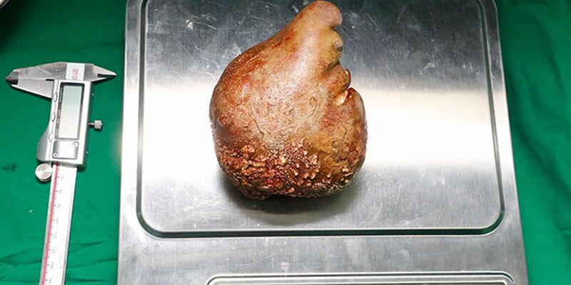 Das Foto zeigt den Nierenstein auf einer Waage. - Foto: Sri Lanka Army/dpa