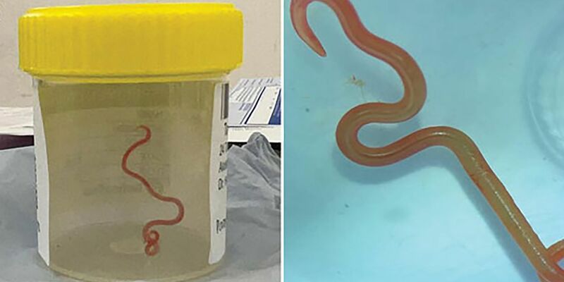 Der lebende Spulwurm «Ophidascaris robertsi» wurde im Gehirn einer 64-jährigen Australierin gefunden. - Foto: Emerging Infectious Diseases/AAP/dpa