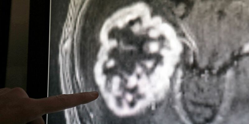 Insgesamt starben 2019 mehr als eine Million Menschen unter 50 Jahren an Krebs, was einem Anstieg um knapp 28 Prozent im Vergleich zu 1990 entspricht - Foto: picture alliance / Bernd Wüstneck/dpa