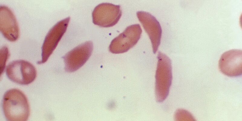 Mikroskopbild zeigt halbmondförmige rote Blutkörperchen eines an Sichelzellenanämie erkrankten Patienten aus dem Jahr 1972. - Foto: F. Gilbert/CDC/AP