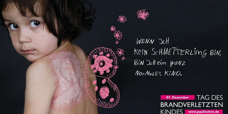 Tag des brandverletzten Kindes am 7. Dezember / Brandheiß! Brandgefährlich! Brandverletzt - Foto: presseportal.de