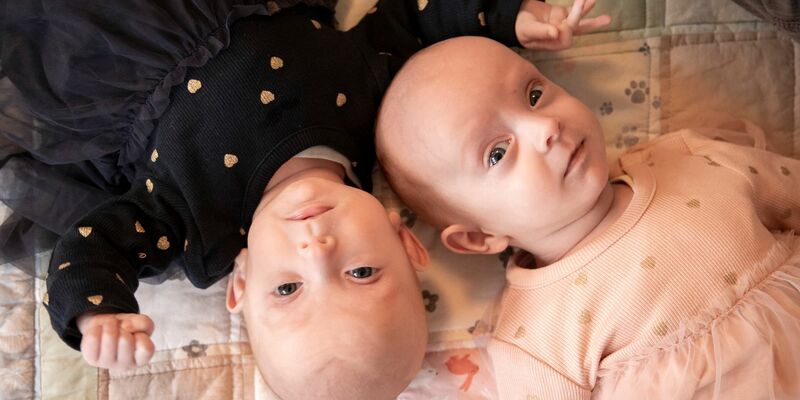 Einst am Bauch verbundene Zwillinge liegen nach der erfolgreichen Trennung Kopf an Kopf nebeneinander. - Foto: Eva Hecht/UKE/dpa