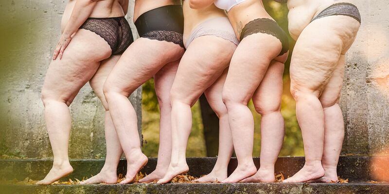 Frauen mit Lipödem-Erkrankung. Betroffene kämpfen für eine Ent-Stigmatisierung der Krankheit und fordern mehr kompetente Ärzte. - Foto: Carina Gorny Fotografie/Lipödem-Gesellschaft/dpa