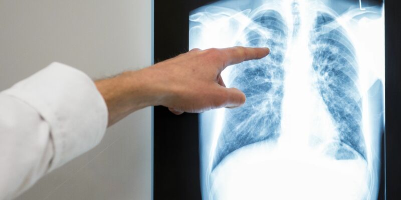 Röntgenbild einer Lunge. Im vergangenem Jahr würden rund 4480 neue Tuberkulose-Fälle in Deutschland registriert. - Foto: Silas Stein/dpa