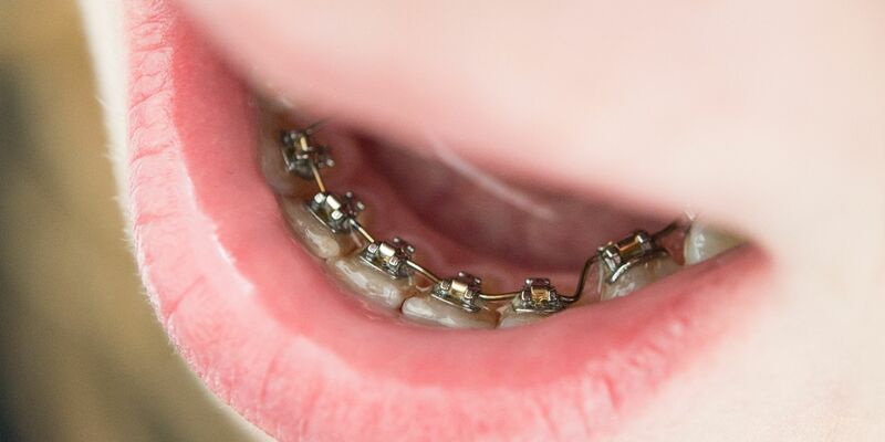 Gegen schiefe Zähne hilft eine Zahnspange. - Foto: Franziska Gabbert/dpa
