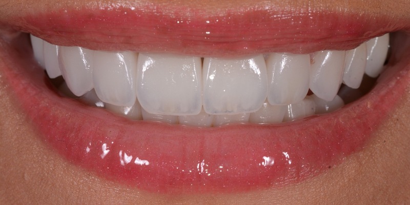 Aligner aus dem Onlineshop? Zahnarzt verrät, welche 5 Risiken diese Methode zur Zahnkorrektur birgt - Foto: presseportal.de