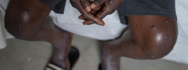 In Afrika fehlt Mpox-Impfstoff. (Archivbild) - Foto: Moses Sawasawa/AP