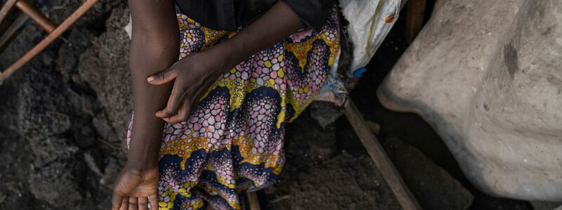 In Afrika gibt es schon 14.000 Mpox-Verdachtsfälle. - Foto: Moses Sawasawa/AP/dpa