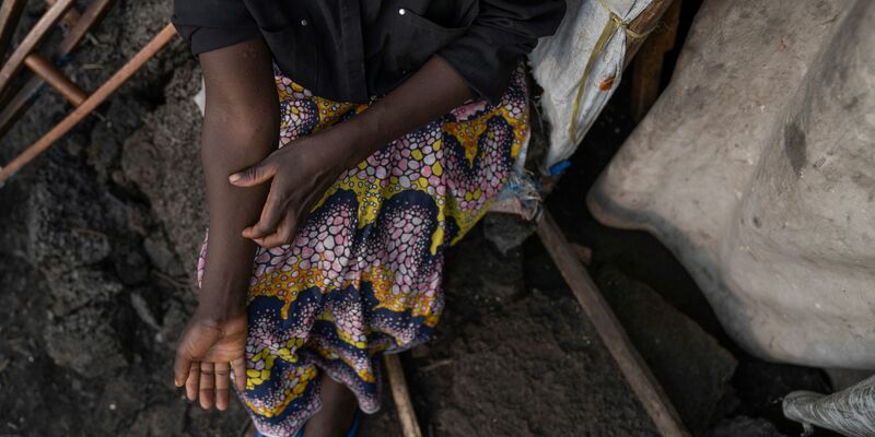 Ein erster Fall von Mpox ist in Deutschland nachgewiesen worden (Foto Archiv) - Foto: Moses Sawasawa/AP/dpa
