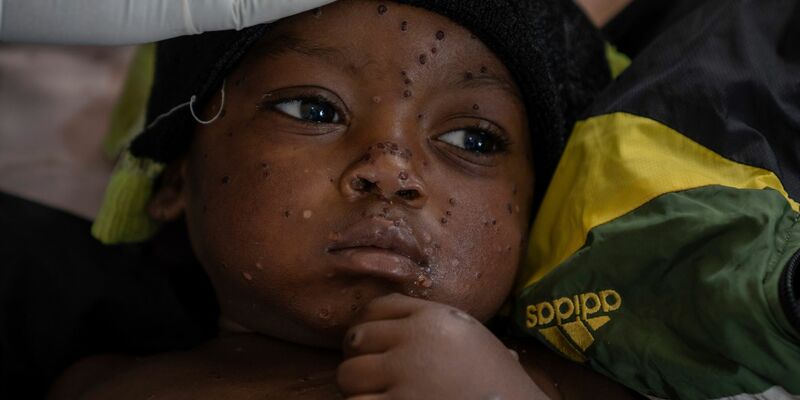 Neue Tests sollen die Ausbreitung von Mpox eindämmen helfen. (Archivbild) - Foto: Moses Sawasawa/AP/dpa