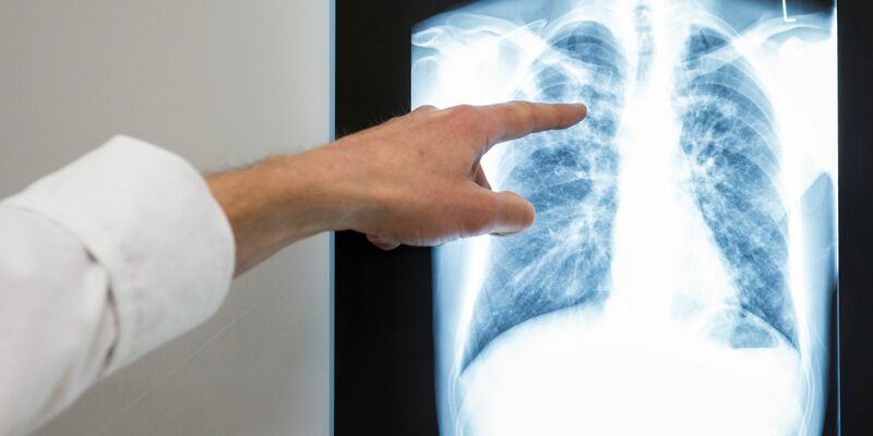 TB war 2023 unter Infektionskrankheiten die häufigste Todesursache. - Foto: Silas Stein/dpa