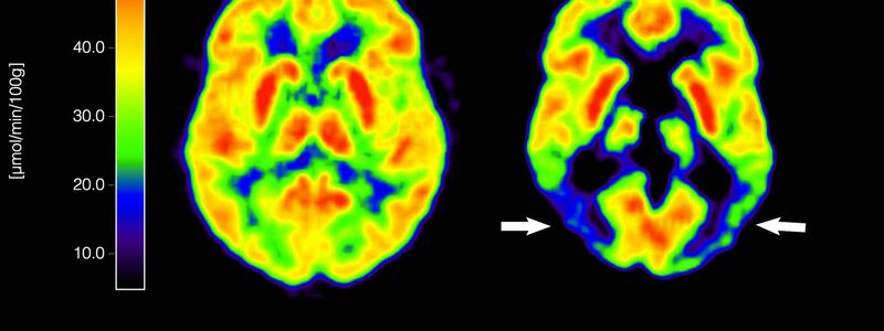 Haben die Amyloid-Plaques schon irreversible Schäden im Gehirn angerichtet, nützt ihre Entfernung nichts mehr. (Archivbild) - Foto: picture alliance / dpa