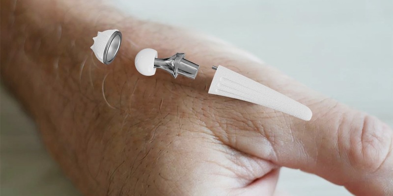 300. Implantation der Touch-Daumensattelgelenksprothese am RHÖN-KLINIKUM Campus Bad Neustadt - Foto: presseportal.de