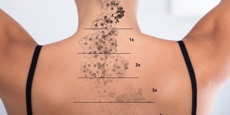 Dermatologie Quist: Tattooentfernung mit dem Picosekundenlaser – alles über Vorteile, Risiken und Vorgang - Foto: presseportal.de