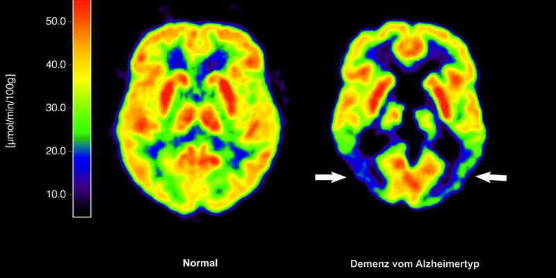 Lecanemab richtet sich gegen Amyloid-Ablagerungen im Gehirn und soll dadurch den Verlauf der Krankheit ein wenig verlangsamen. (Archivbild) - Foto: Lutz Kracht/MPI/dpa