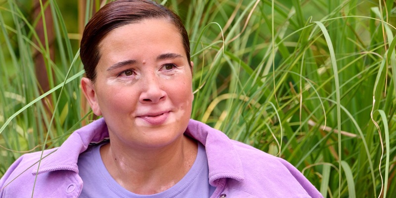 Aktuelle Behandlungsmöglichkeiten für Menschen mit Vitiligo im Jahr 2025 - Foto: presseportal.de