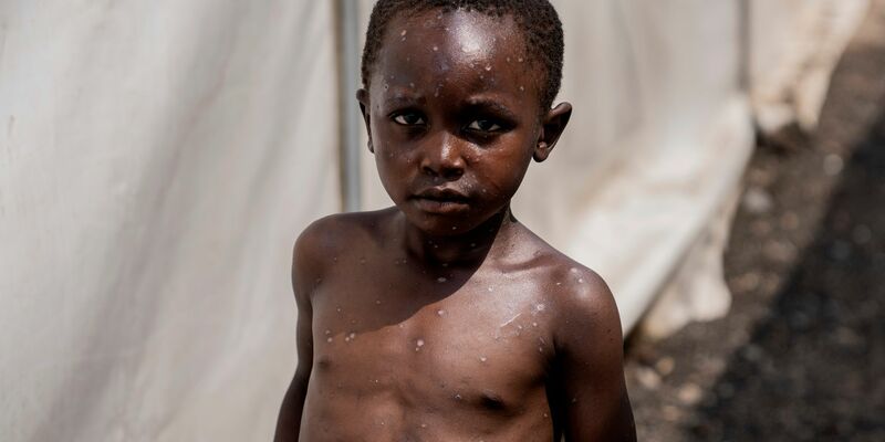 Für Kinder kann Mpox besonders gefährlich sein (Archivbild)  - Foto: Moses Sawasawa/AP/dpa