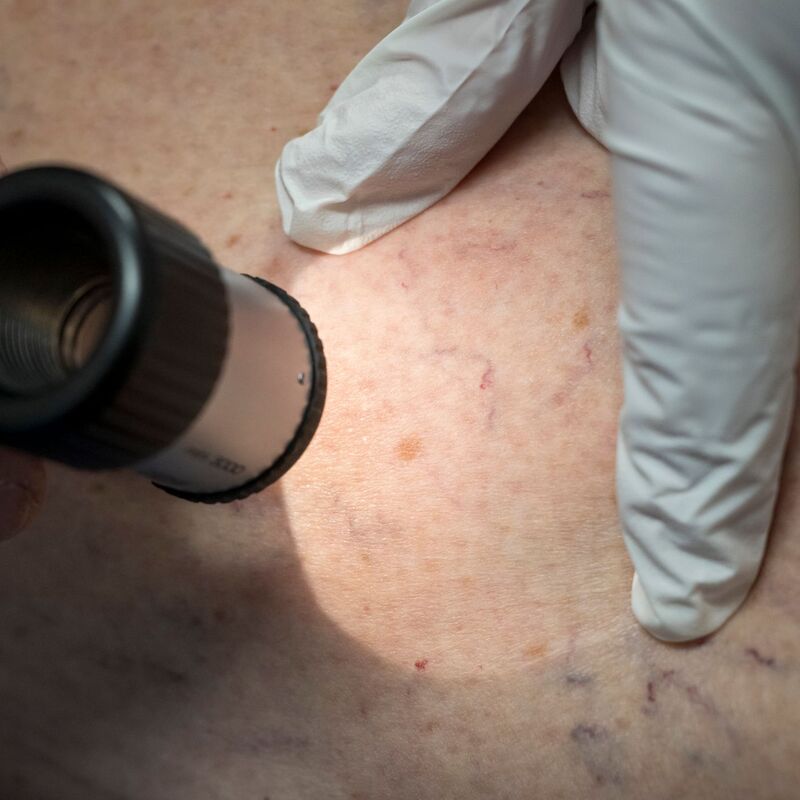 Ein Arzt untersucht in der Praxis die Hautpartie eines Patienten. (Archivbild) - Foto: Peter Kneffel/dpa