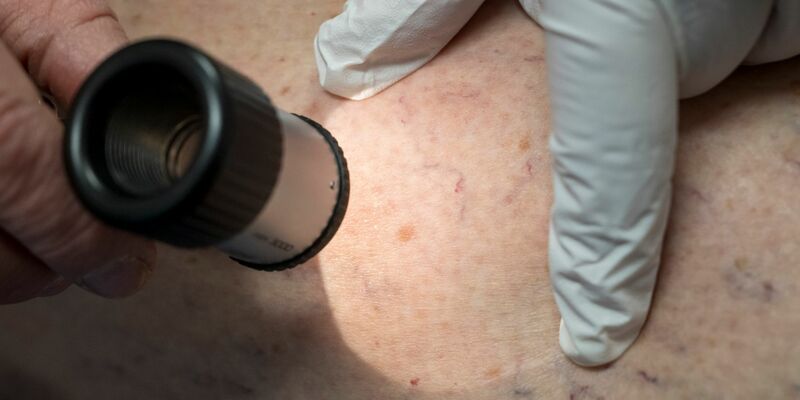 Die Zahl der Krankenhausbehandlungen von Hautkrebs stieg enorm an. (Symbolbild) - Foto: Peter Kneffel/dpa