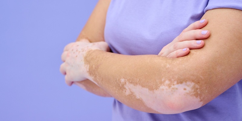 Beratung für Vitiligo-Betroffene: Incyte Deutschland unterstützt die Hautwochen - Foto: presseportal.de