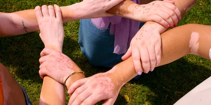 Weißfleckenkrankheit in Deutschland: Neue Daten zeigen Lücken in Versorgung und Aufklärung von Menschen mit Vitiligo - Foto: presseportal.de
