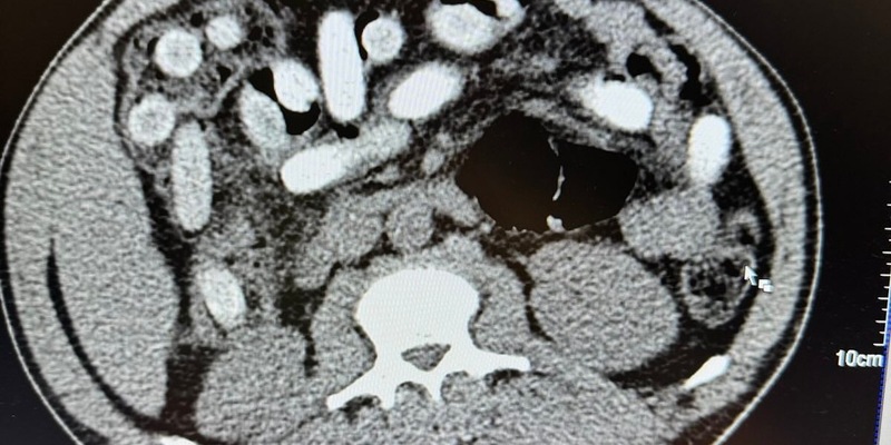 HZA-K: Kölner Zoll stellt Körperschmuggler im Bus und im Zug / 50-jähriger Italiener stellt mit rund 1,3 Kilogramm Kokain im Bauch neuen traurigen Rekord auf - Mutter und Tochter verstecken Heroin im Körper - Foto: presseportal.de