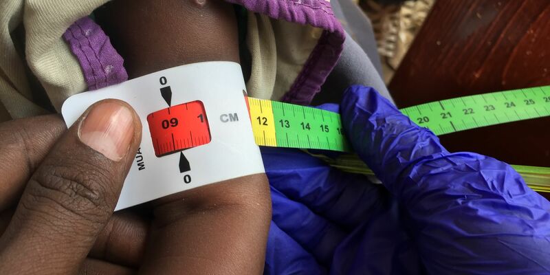 Ein Arzt misst im Sudan den Armumfang eines schwer unterernährten Babys (Archivbild) - Foto: Eva-Maria Krafczyk/dpa