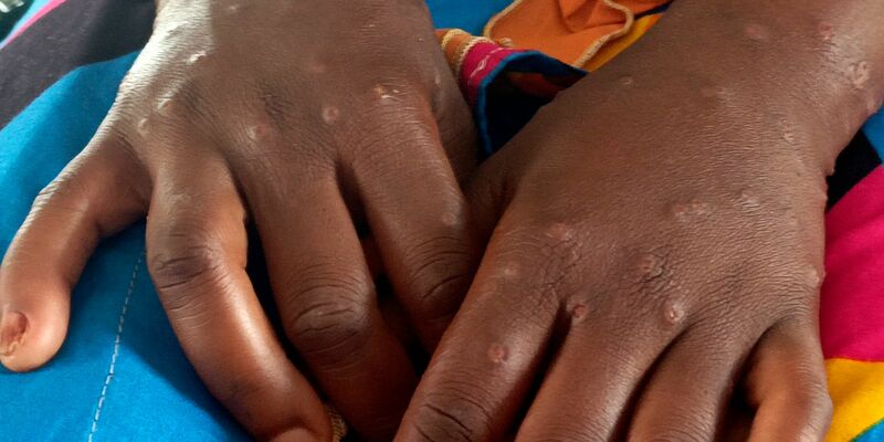 Mpox ist vor allem für kleine Kinder und immungeschwächte Menschen gefährlich (Archivbild) - Foto: Janvier Barhahiga/AP/dpa