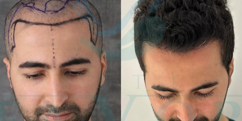 Top 10 Beste Haartransplantation Kliniken in der Türkei - Foto: presseportal.de