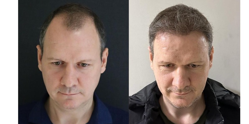 Die 10 Besten Haartransplantationskliniken in der Türkei - Kosten, Dauer & Erholungszeit - Foto: presseportal.de