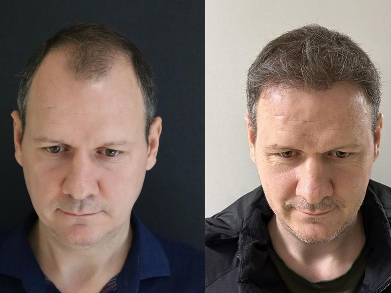 Die 10 Besten Haartransplantationskliniken in der Türkei - Kosten, Dauer & Erholungszeit - Foto: presseportal.de