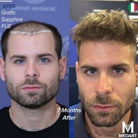 Die 10 besten Haartransplantationszentren in der Türkei: Kompletter Ratgeber für ausländische Patienten 2026 - Foto: presseportal.de