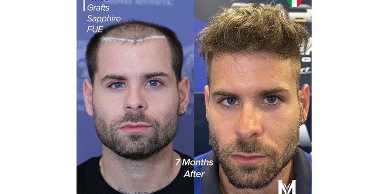 Die 10 besten Haartransplantationszentren in der Türkei: Kompletter Ratgeber für ausländische Patienten 2026 - Foto: presseportal.de