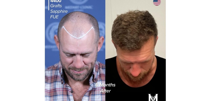 Die 10 Besten Haartransplantationszentren in der Türkei: Schmerzen, Komfort und häufige Patientenfragen - Foto: presseportal.de