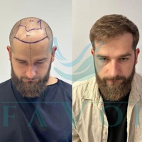 Die 10 besten Haartransplantationskliniken in der Türkei - Risiken, Sicherheit & Qualität - Foto: presseportal.de