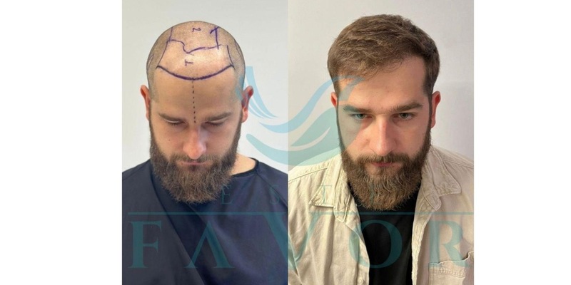 Die 10 besten Haartransplantationskliniken in der Türkei - Risiken, Sicherheit & Qualität - Foto: presseportal.de