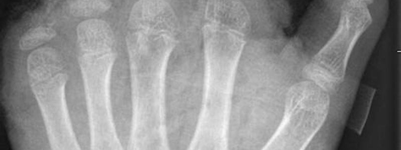 So kann ein Röntgenbild nach einer missglückten Böllerexplosion aussehen: Zwei Finger fehlen.  - Foto: -/UKB/dpa