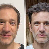 Haartransplantation Türkei Testsieger 2026: Die 10 besten Kliniken im großen Vergleich - Foto: presseportal.de