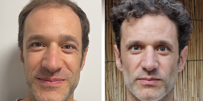 Haartransplantation Türkei Testsieger 2026: Die 10 besten Kliniken im großen Vergleich - Foto: presseportal.de