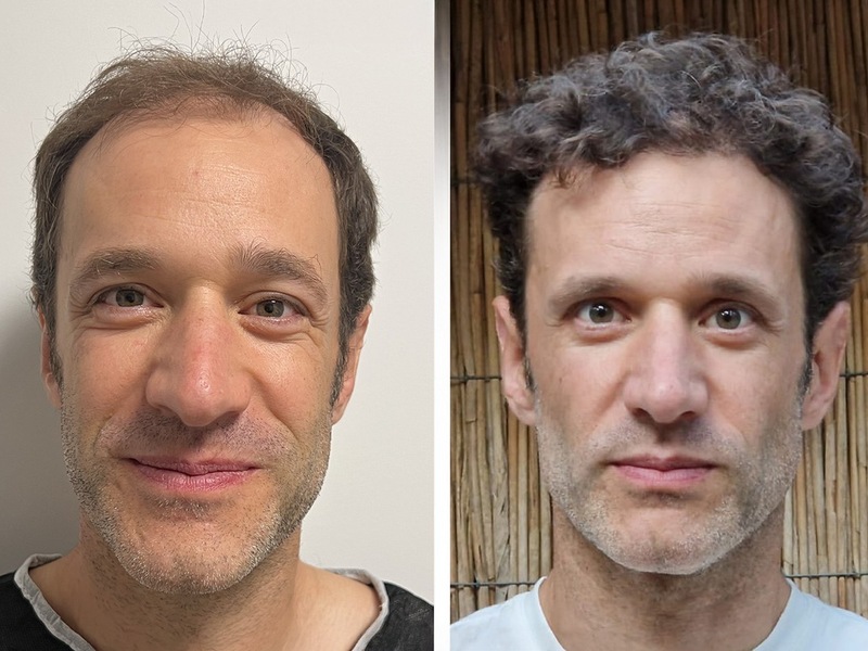 Haartransplantation Türkei Testsieger 2026: Die 10 besten Kliniken im großen Vergleich - Foto: presseportal.de