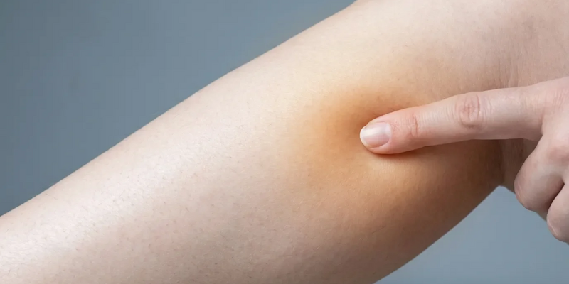 Akupressur-Punkt Chengshan: Erste Hilfe bei winterlichen Wadenkrämpfen - Foto: über boerse-global.de