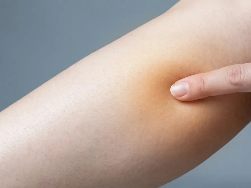 Akupressur-Punkt Chengshan: Erste Hilfe bei winterlichen Wadenkrämpfen - Foto: über boerse-global.de