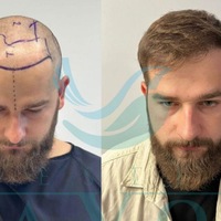 Haartransplantation Türkei 2026 - Die 10 besten Kliniken im großen Testsieger-Vergleich - Foto: presseportal.de