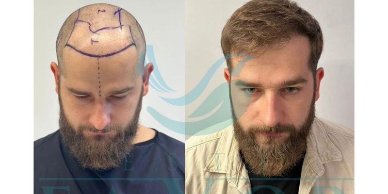 Top 10 Beste Haartransplantation Türkei 2026 - Testsieger & Klinik-Vergleich - Foto: presseportal.de