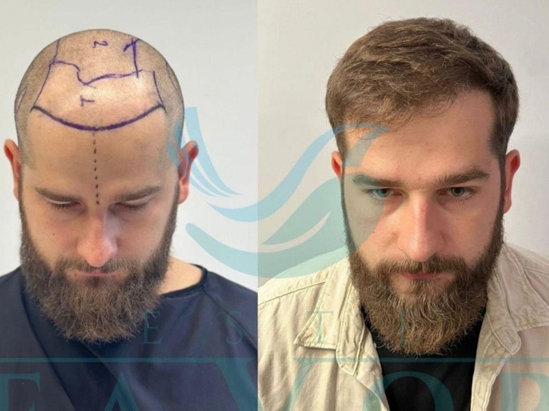 Top 10 Beste Haartransplantation TĂŒrkei 2026 - Testsieger & Klinik-Vergleich - Foto: presseportal.de