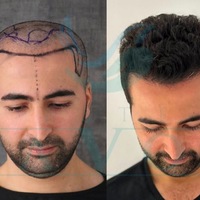 Haartransplantation Türkei 2026 - Top 10 beste Kliniken im großen Testsieger-Vergleich - Foto: presseportal.de