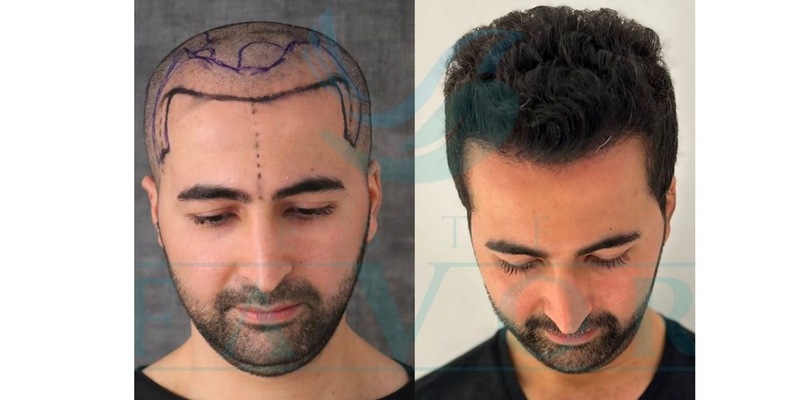 Top 10 Beste Haartransplantation Türkei in der Türkei 2026: testsieger Haartransplantationskliniken - Foto: presseportal.de