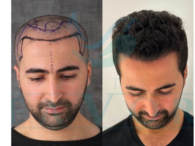 Haartransplantation Türkei 2026 - Top 10 beste Kliniken im großen Testsieger-Vergleich - Foto: presseportal.de