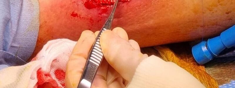 Das Omega-3 in der Fischhaut fördert die Heilung großer Wunden.  - Foto: Saziye Karaca/-/dpa