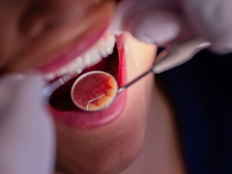 Zahnarztbehandlungen sollen nach dem Willen des CDU-Wirtschaftsrats «nicht lÀnger im Umlageverfahren den Beitragszahlern zur Last fallen». (Symbolbild) - Foto: Rolf Vennenbernd/dpa